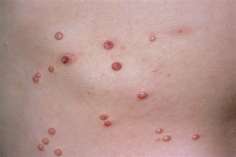 cimetidine for molluscum contagiosum